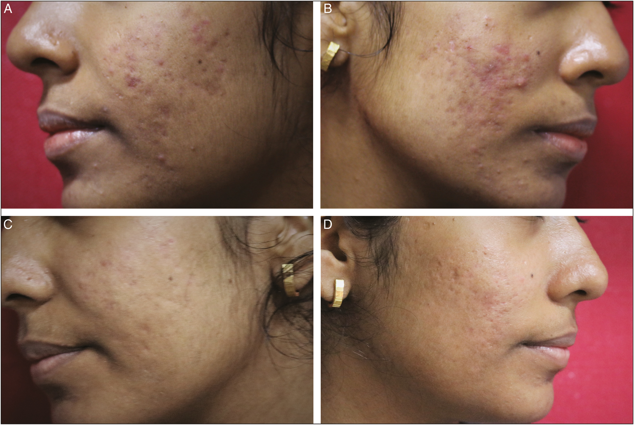Acne Scar Treatment - Before